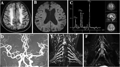 A case report of neuronal intranuclear inclusion disease with paroxysmal peripheral neuropathy-like onset lacking typical signs on diffusion-weighted imaging